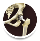 hip_joint_replacement